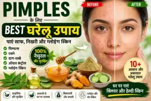 ◆ 7 Din me Pimples Kaise Hataye Naturally | Complete Home Treatment